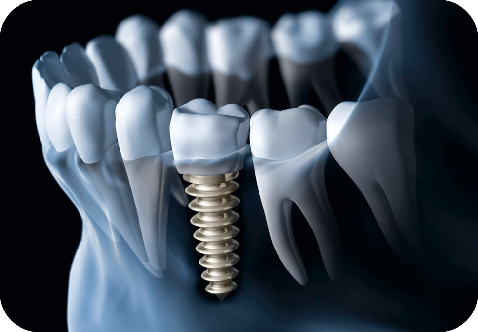 implant unitaire docteur arthur arnaud geneve morges Implant unitaire Drs. Arnaud, Hugentobler & Oeggerli, Chirurgie orale | Genève