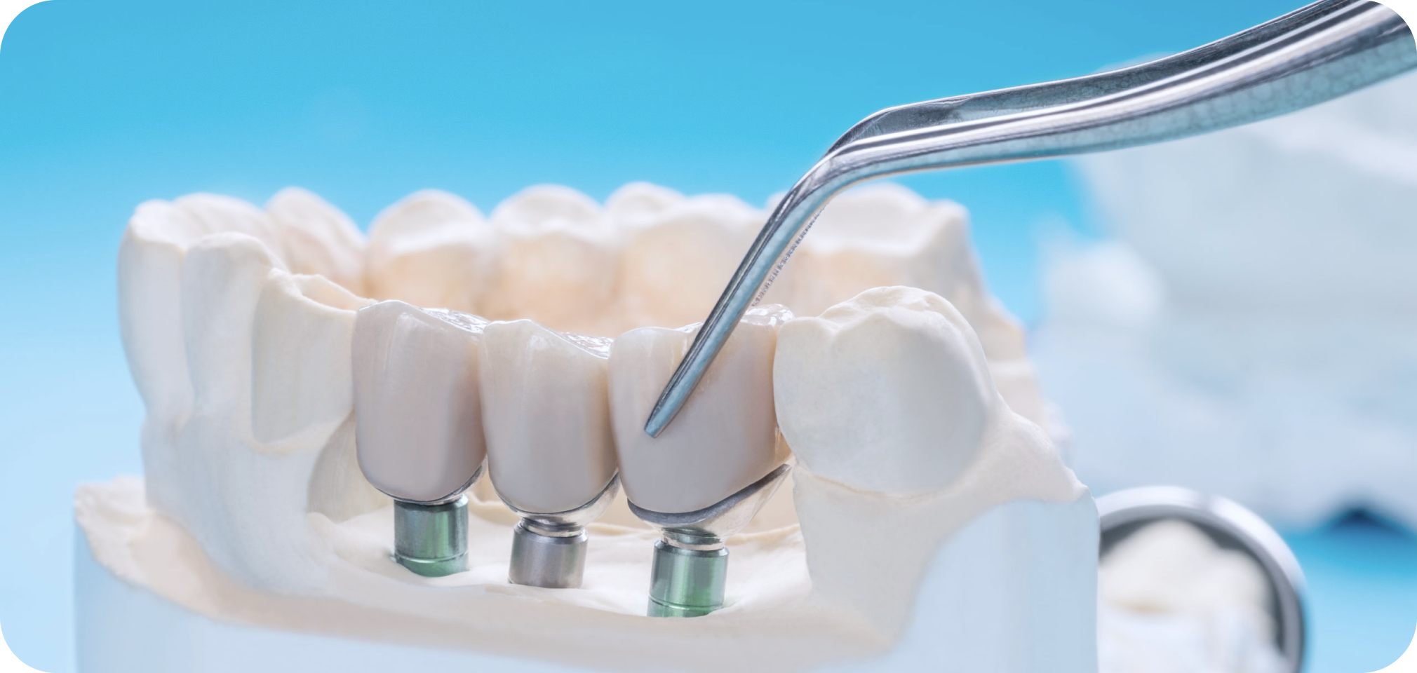 implants dentaires docteur arthur arnaud geneve morges Implant unitaire Drs. Arnaud, Hugentobler & Oeggerli, Chirurgie orale | Genève