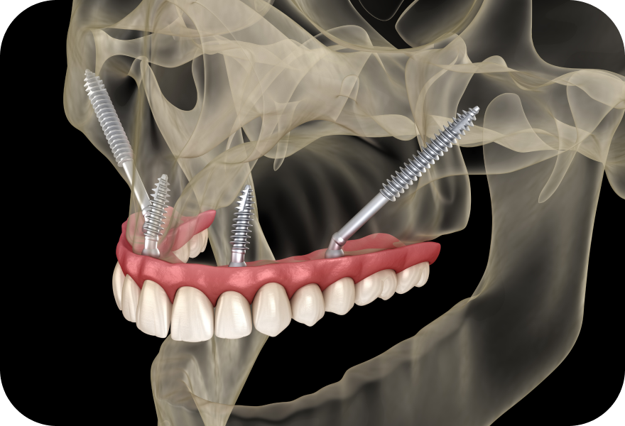 Zygomatic implants in Geneva for complete rehabilitation of the upper jaw