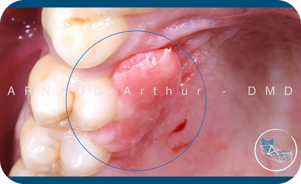 Biopsie et exérèse de lésions muqueuses Drs. Arnaud, Hugentobler & Oeggerli | Oral Surgery | Geneva