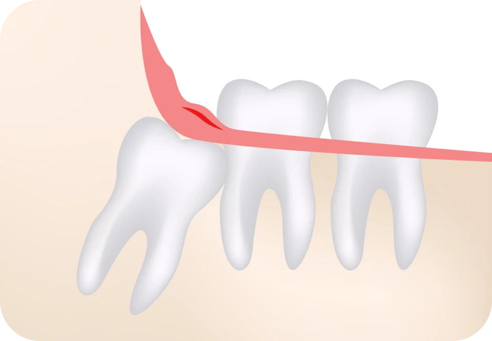 dents sagesse docteur arthur arnaud geneve morges Dents de sagesse Drs. Arnaud, Hugentobler & Oeggerli, Chirurgie orale | Genève