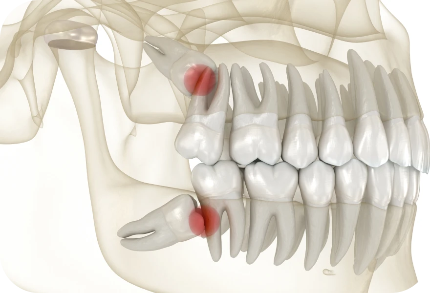 Dents de sagesse, Dr. Arnaud, chirurgien oral à Genève et à Morges