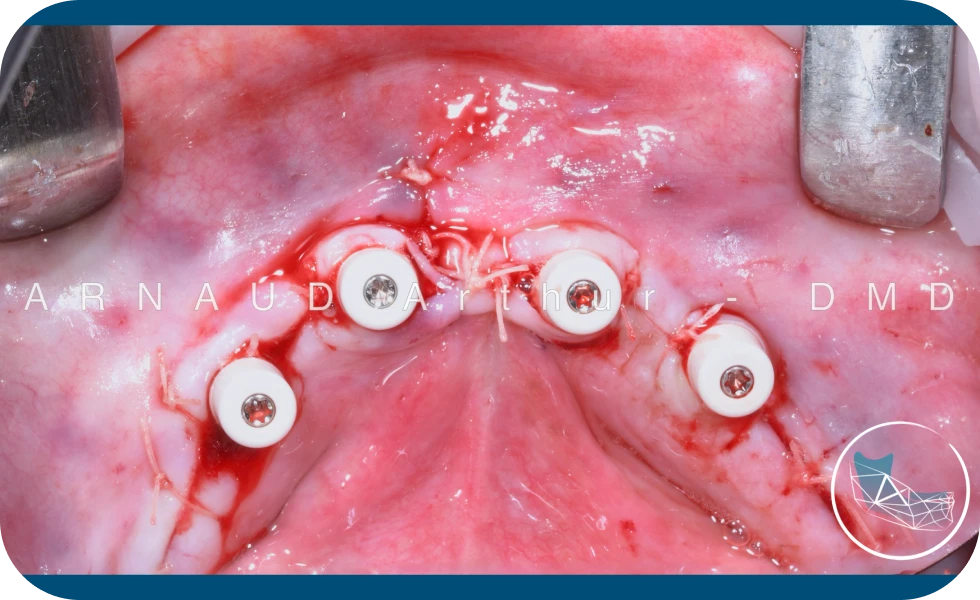 Traitement édenté complet par Dr. Arthur Arnaud, spécialiste en chirurgie orale à Genève