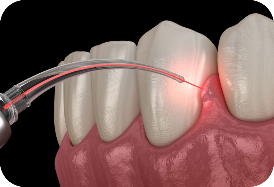 Laser frenectomy in Geneva to treat a bothersome buccal frenulum