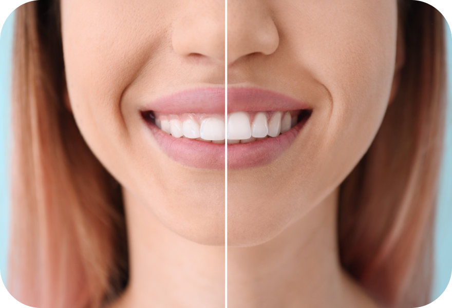 Gingivectomie esthétique Drs. Arnaud, Hugentobler & Oeggerli, Chirurgie orale | Genève