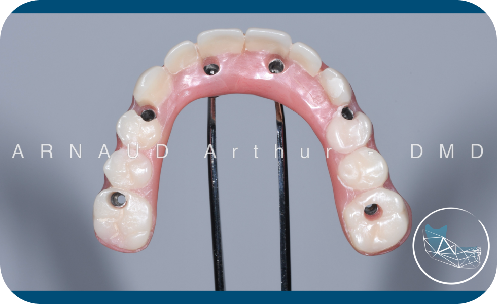 All-on-X Drs. Arnaud, Hugentobler & Oeggerli, Chirurgie orale | Genève