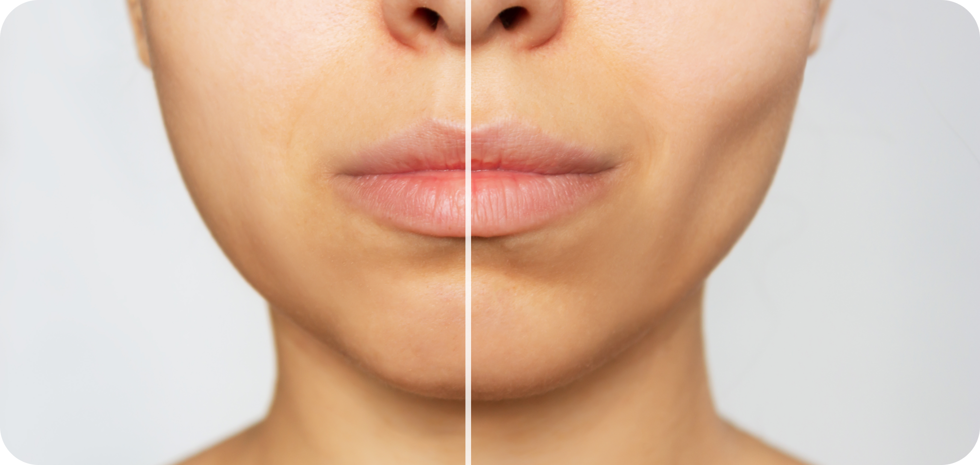 chirurgie esthetique visage geneve Bichectomie Drs. Arnaud, Hugentobler & Oeggerli, Chirurgie orale | Genève