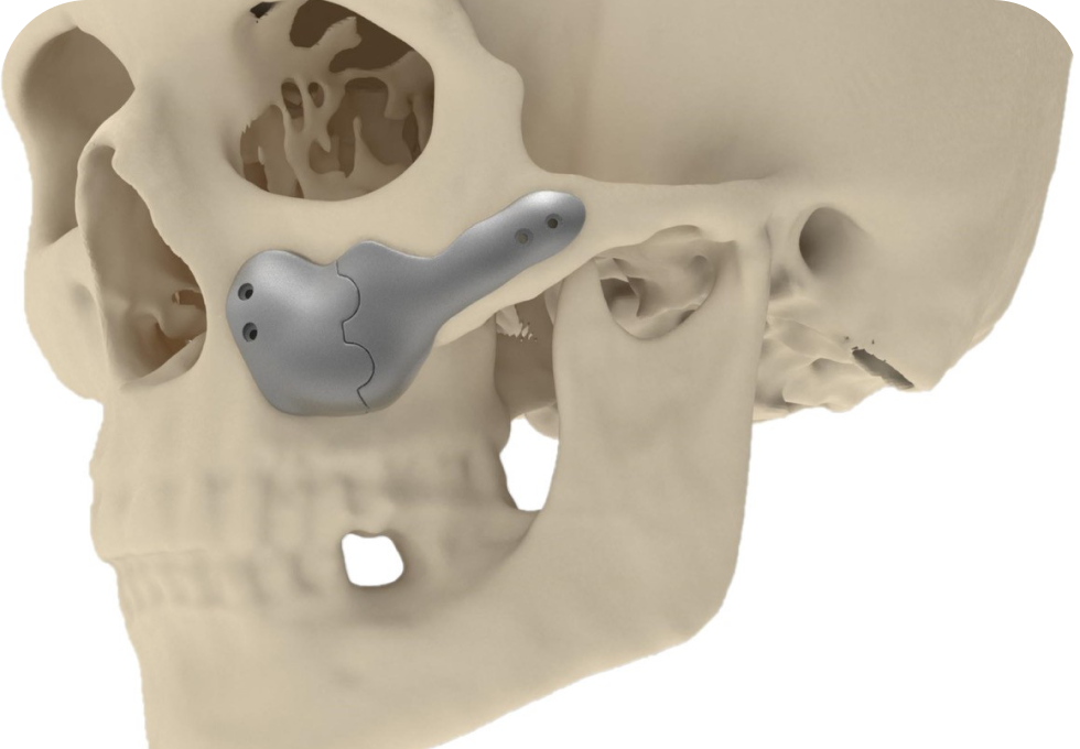 implants faciaux chirurgie orale maxillo faciale Implants faciaux Drs. Arnaud, Hugentobler & Oeggerli, Chirurgie orale | Genève