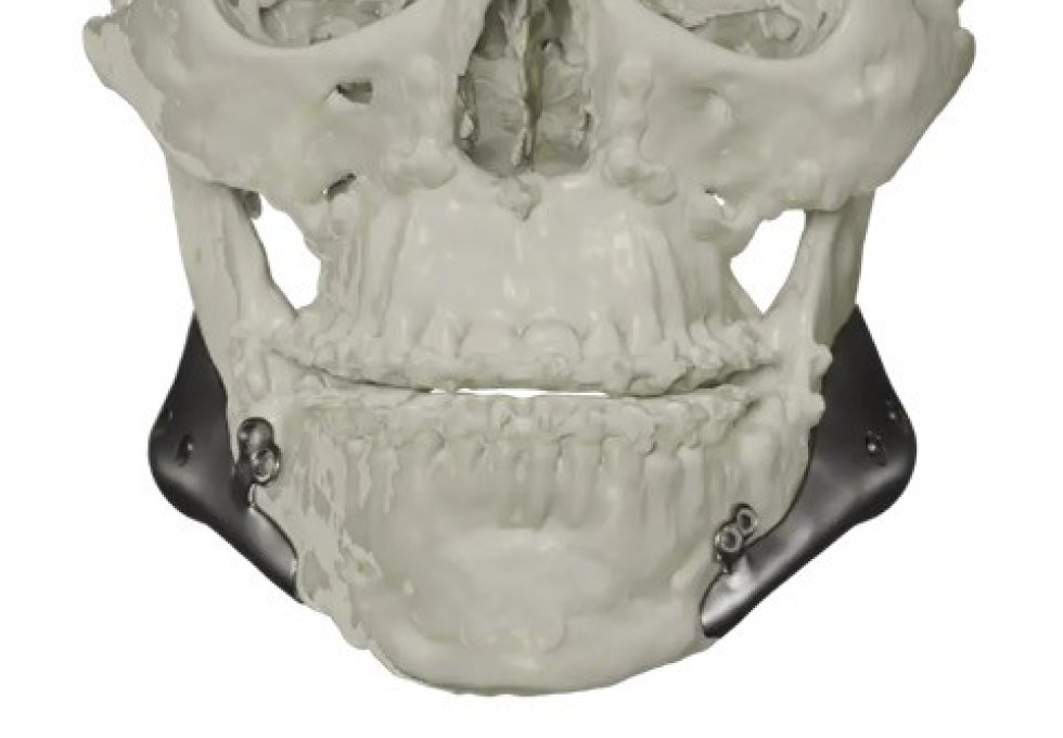 implants faciaux geneve machoire Implants faciaux Drs. Arnaud, Hugentobler & Oeggerli, Chirurgie orale | Genève