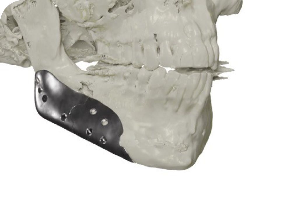 implants faciaux protheses angle mandibulaire Implants faciaux Drs. Arnaud, Hugentobler & Oeggerli, Chirurgie orale | Genève