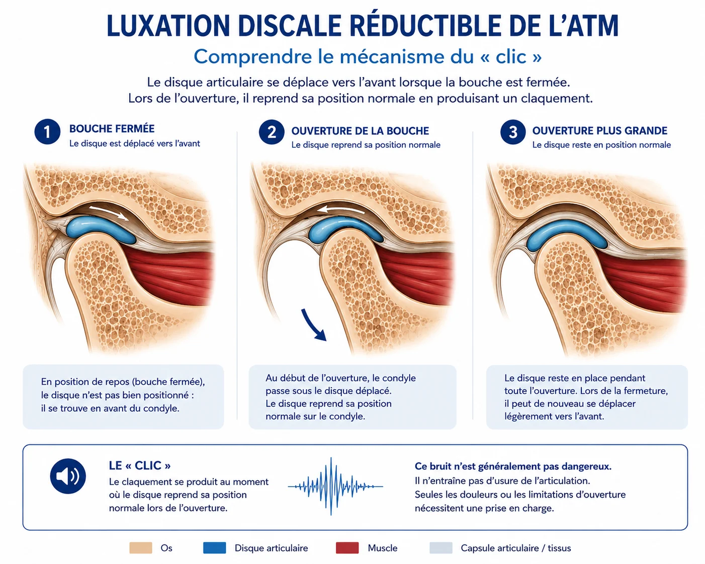 Luxation discale réductible de l’ATM : comprendre le mécanisme du clic, schéma explicatif
